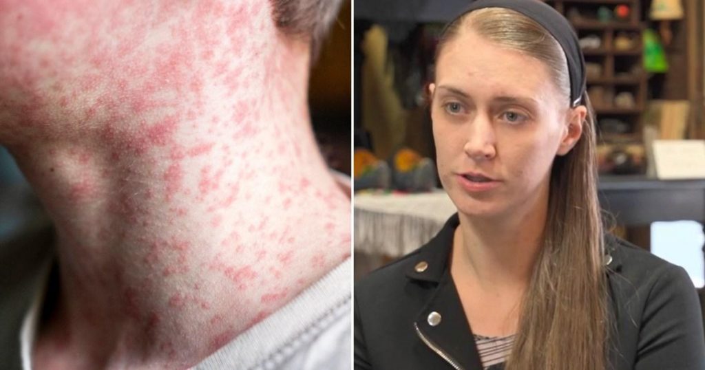 Anti-vax parents say 'measles wasn't that bad' after daughter dies in outbreak | News US