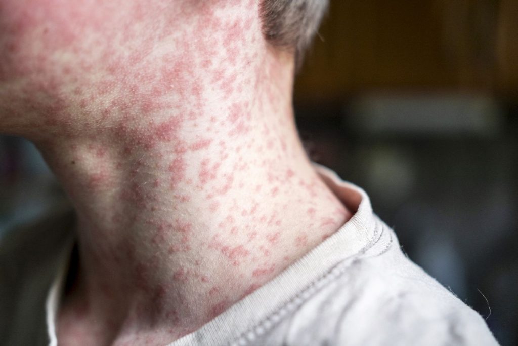 Pediatrician Responds to Parents Whose Unvaccinated Child Died from Measles (Exclusive)