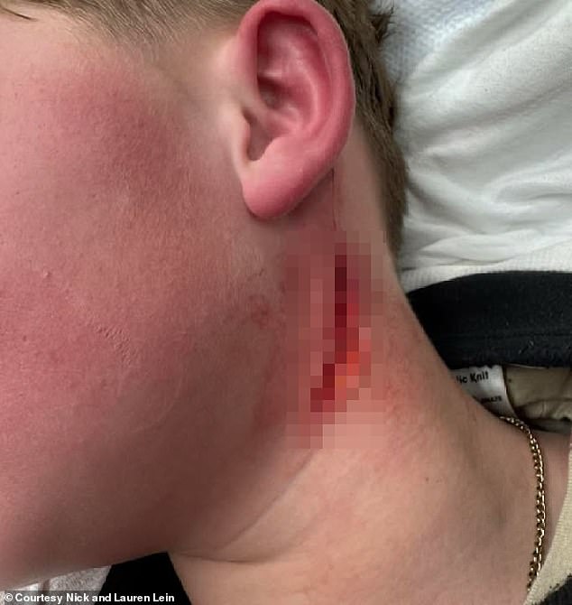 Wyoming boy, 11, suffers 'parent's worst nightmare' in horrific skating accident