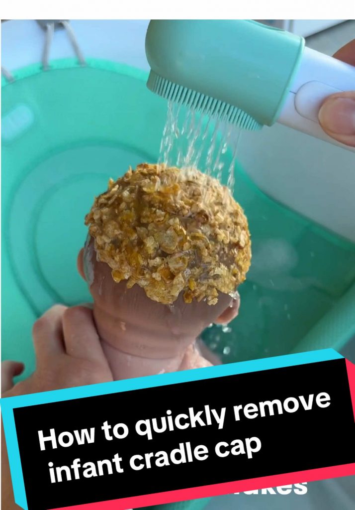 @fridababy Here’s the deal: 7 in 10 babies get cradle cap. So chances are you’ll...