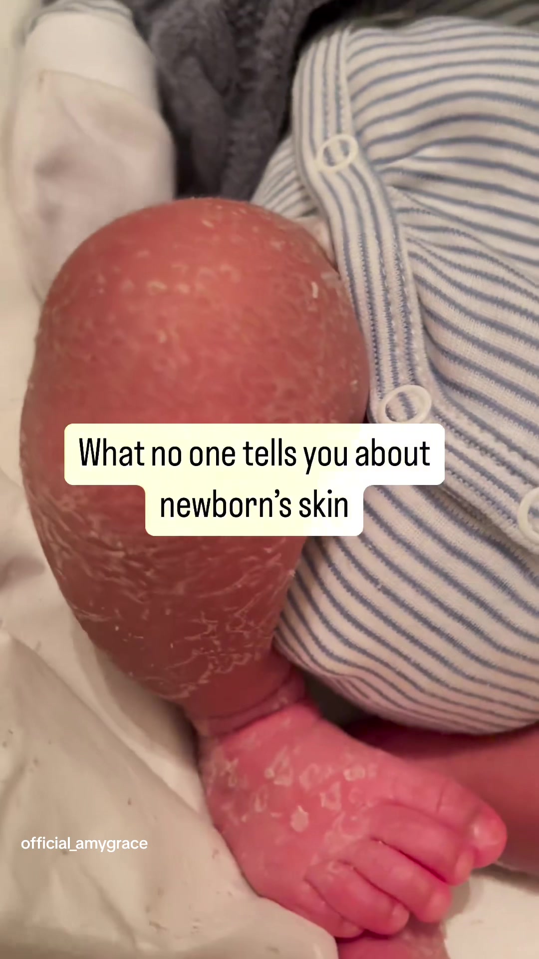 @official_amygrace Here you are advised to not bath your baby till the cord fall...