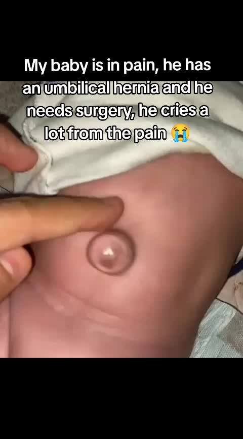 @gigisvloggaza Hello my friends, I am upset because my baby has an umbilical her...